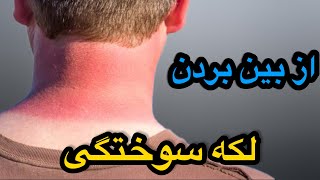 از بین بردن لکه ها سوختکی با روش های خانگی