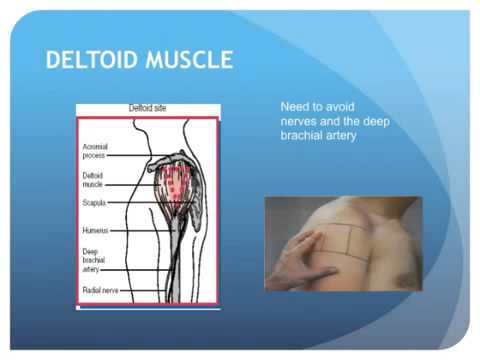 Места внутримышечной инъекции