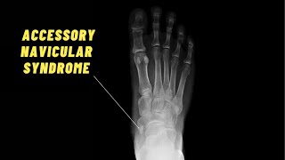 BEST Exercises for Accessory Navicular Syndrome