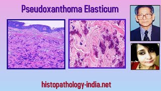 Download lagu Pathology of Pseudoxanthoma Elasticum - Dr Sampurna Roy MD (dermpath, dermatopathology)