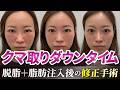 【クマ取り】脱脂・脂肪注入後の裏ミッドフェイスリフト®︎のダウンタイムを公開