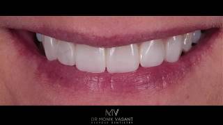 Life changing smile makeover- composite bonding