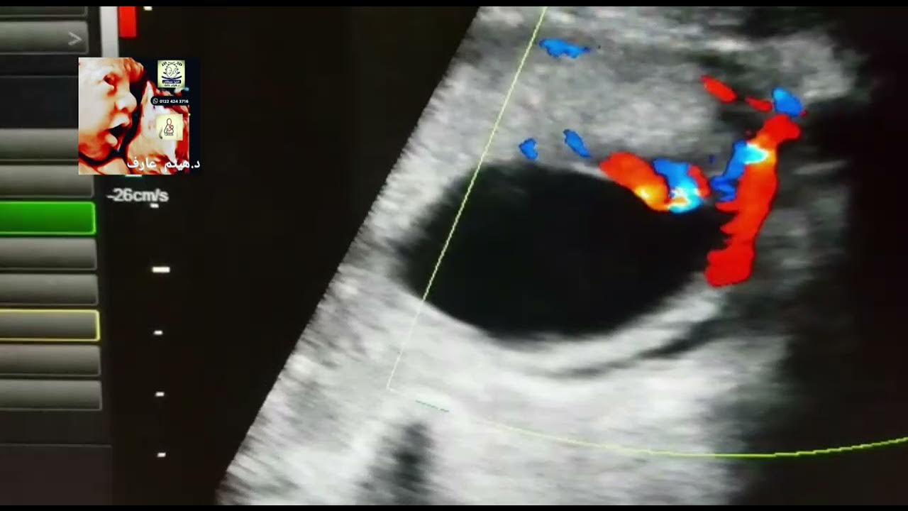 marginal cord insertion ultrasound by Dr.Haissam Aref, DMS, MSc, MD