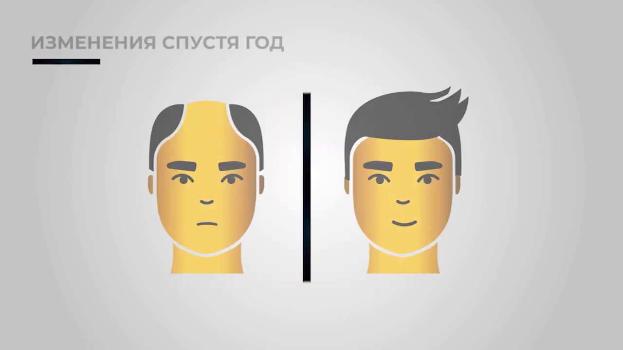 Метод пересадки волос сапфир FUE