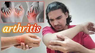 التهاب المفاصل - أسبابه وأعراضه وعلاجه والوقاية منه Arthritis-causes symptoms treatment & prevention
