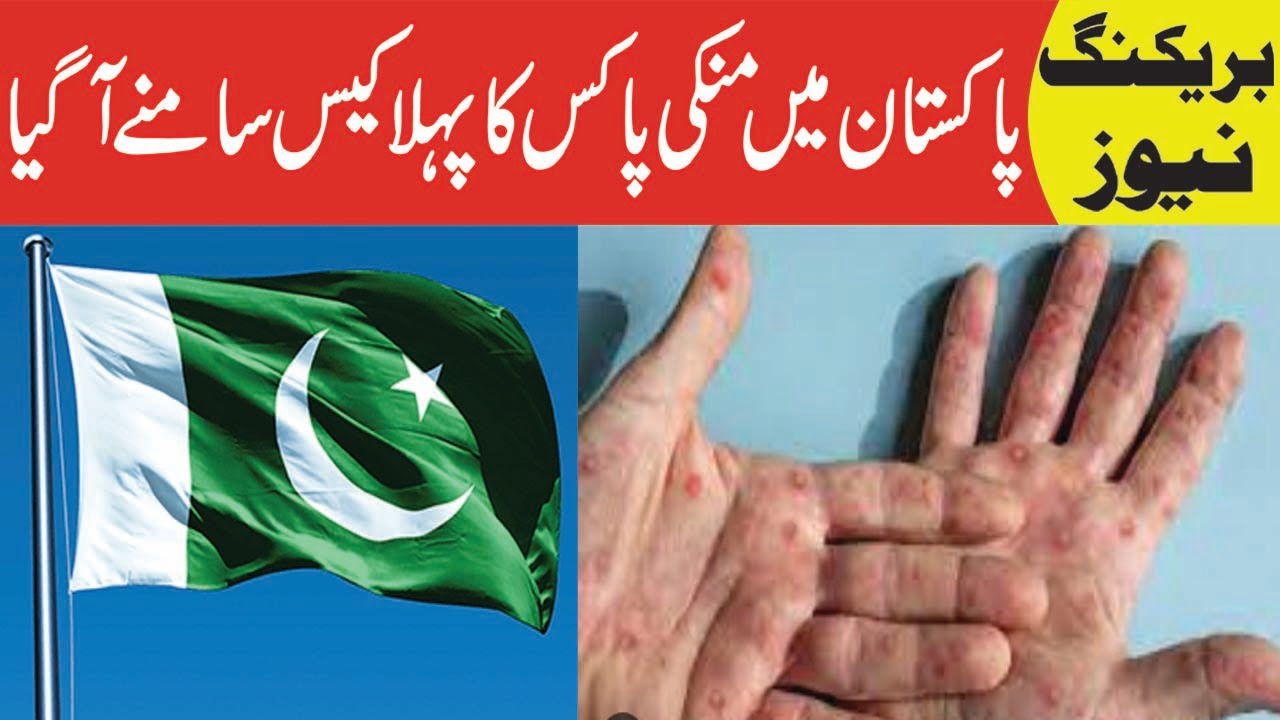 Breaking News The first case of monkeypox was reported in Pakistan ...