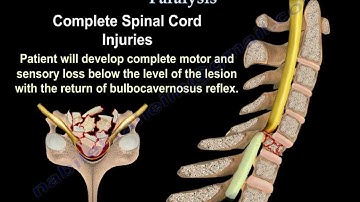 Spinal Cord Injury / Paralysis - Everything You Need To Know - Dr. Nabil Ebraheim