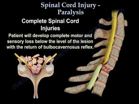 Spinal Cord Injury / Paralysis - Everything You Need To Know - Dr. Nabil Ebraheim