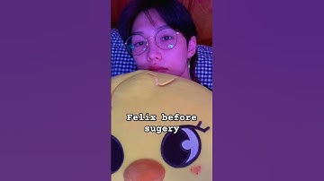 Felix before surgery vs after surgery #straykids #kpop #funny