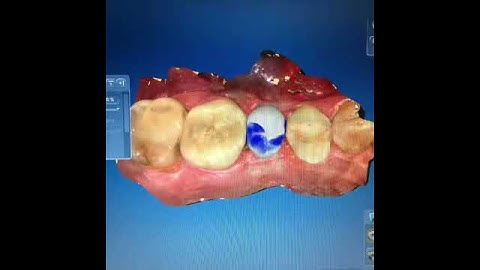 Cerec Cad/Cam Omnicam Emax Porcelain Crown