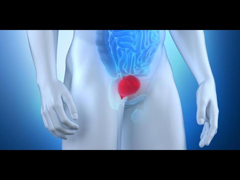 dolor pélvico hombre y dolor pélvico hombre y