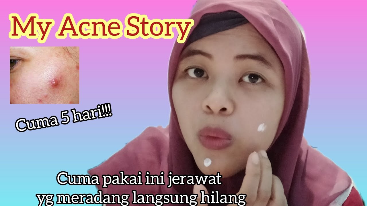CARA MENGATASI JERAWAT YANG MERADANG (MY ACNE STORY)