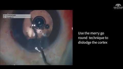 Merry Go Round Technique For Subincisional Cortex Wash