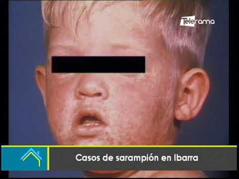 Casos de sarampión en Ibarra