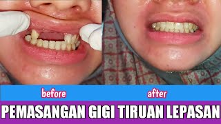 Pemasangan Gigi Tiruan Lepasan Thermoplastic Valplas