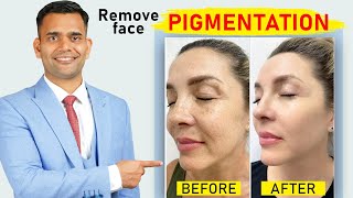 Remove Face Pigmentation Naturally | Melasma | Get Rid Of Melasma, pigmentation and Dark Spots