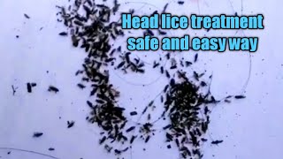 Head lice treatment the safe and easy way\/how to remove lice from natural way\/beauty tips lice