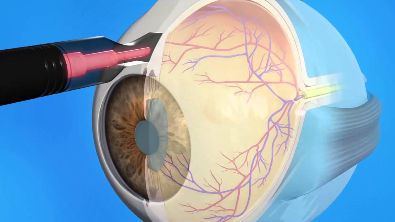При глаукоме можно применять. Криокоагуляция сетчатки. Лазерная транссклеральная циклокоагуляция. Лазерная циклофотокоагуляция глаза. Панретинальная лазерная коагуляция.
