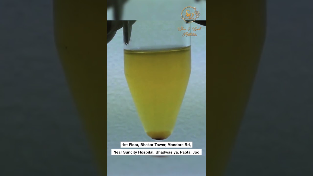 Transform your hair with PRP hair fall procedure! 