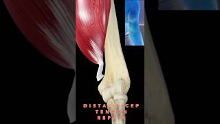 Distal Biceps Tendon Repair - #usmle *Review*