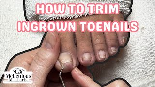 👣How to Trim Big Toenails with Ingrown Toenail Discomfort and Deep Nail Grooves👣