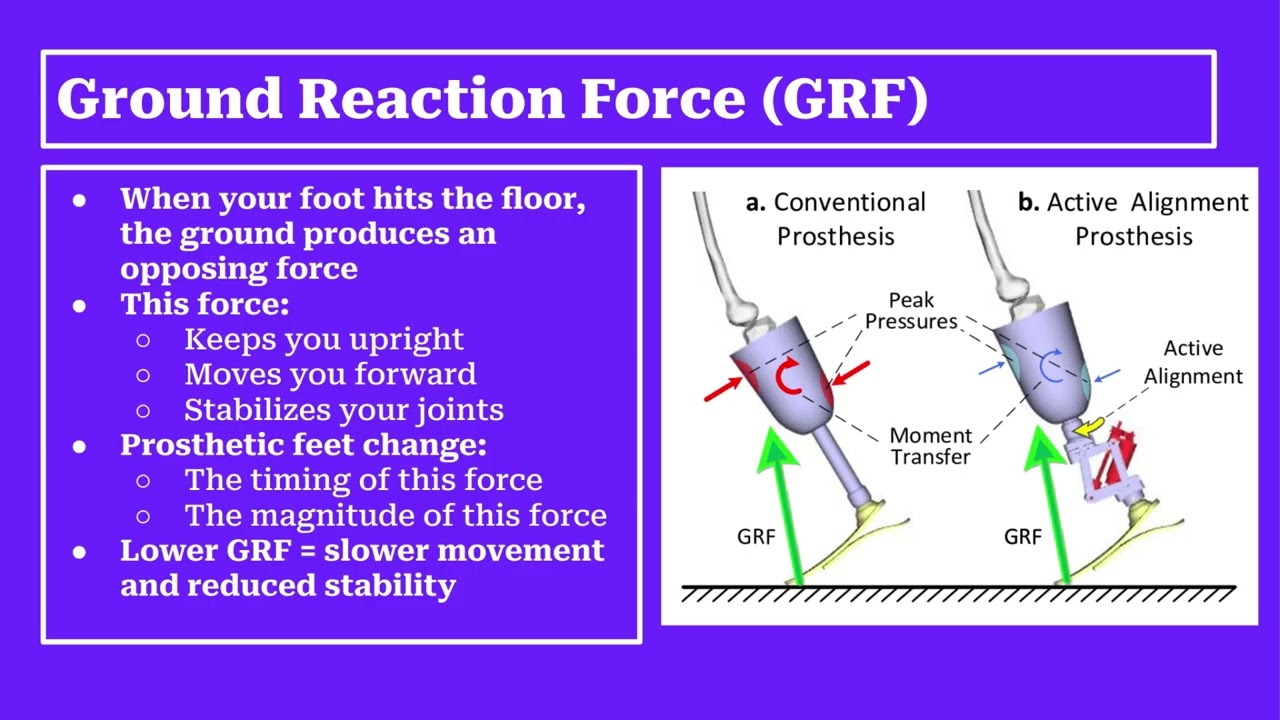 Biomechanics and Prosthetic Feet:How Physics Shapes Human Movement After Limb Loss
