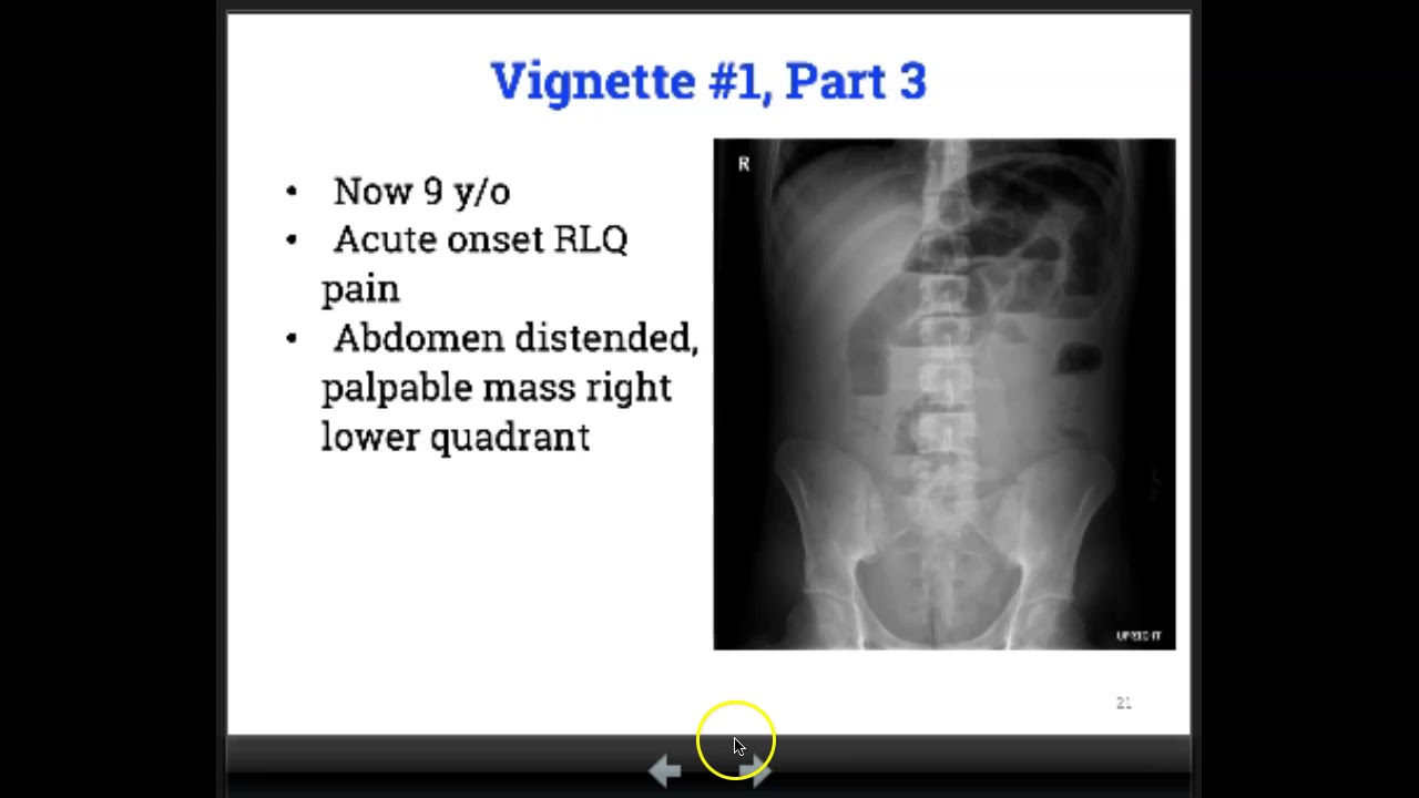 Cystic Fibrosis Gastrointestinal Manifestations, Part 2