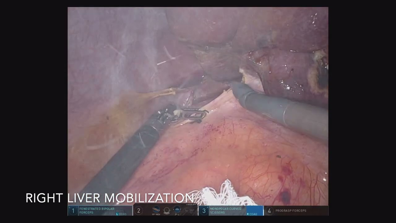 Robotic right hepatectomy