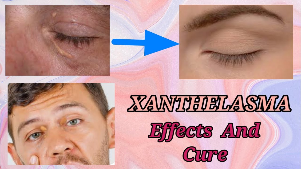 👉XANTHELASMA... EFFECTS, CAUSES, CURE... 👈 YouTube