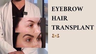 Hair Transplant Does Work For Eyebrows!