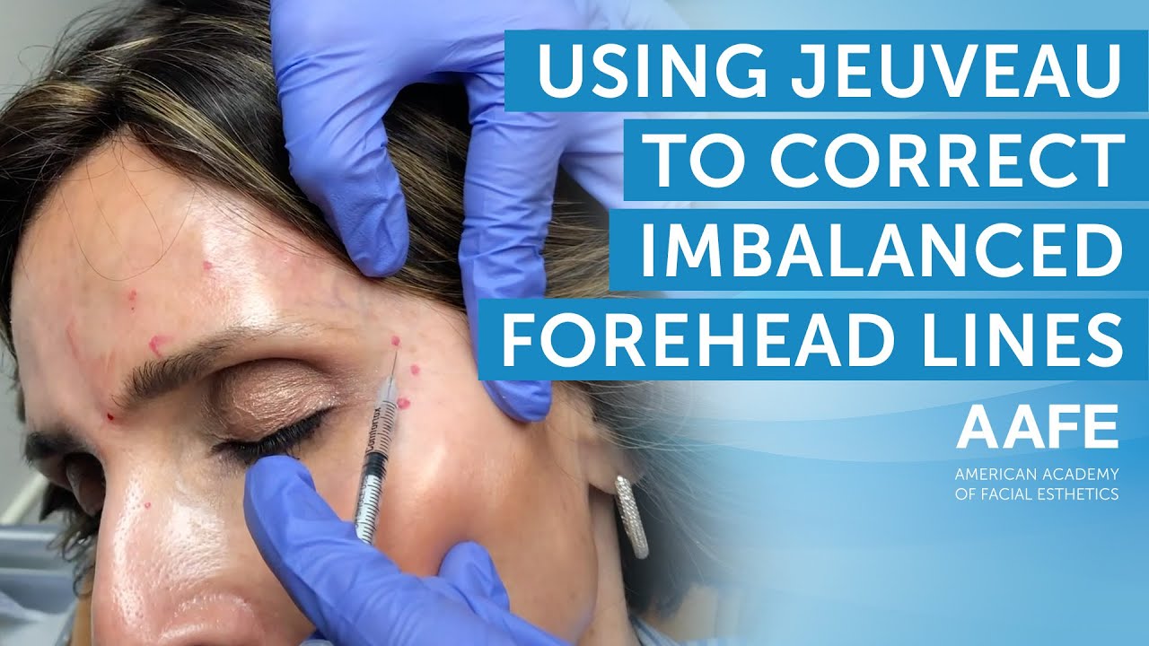Using Jeuveau to Correct Imbalanced Forehead Lines | AAFE - YouTube