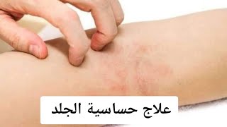 علاج حكة الجسم وحساسيه بسرعة الصاروخ في المنزل