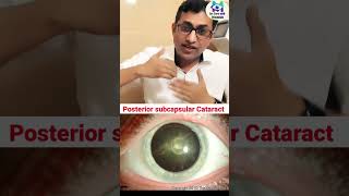Cataract Type-3, Why does glare occur in cataracts