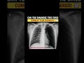 Identify the condition in the Chest Xray?| what is the Diagnosis? @DrHardeepPeads #xray #neetpg
