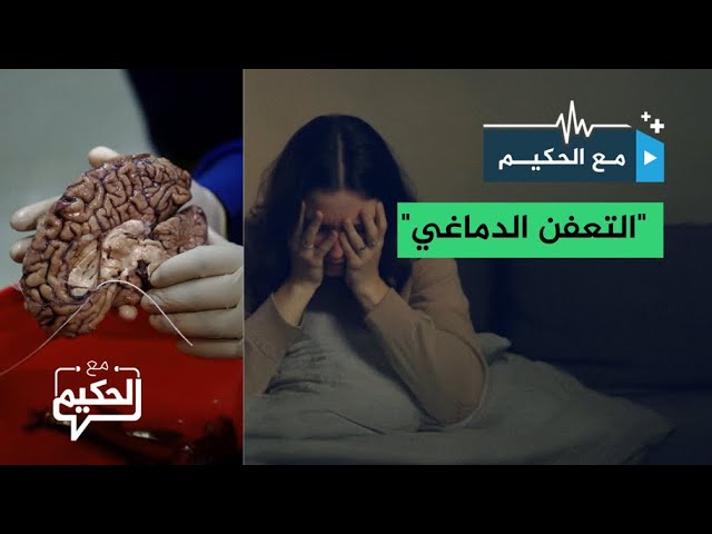 "مرعب".. جائحة التعفن الدماغي تجتاح العالم