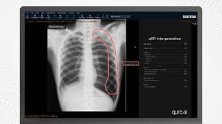 Chest X-Ray AI in action: How qXR overlay looks like