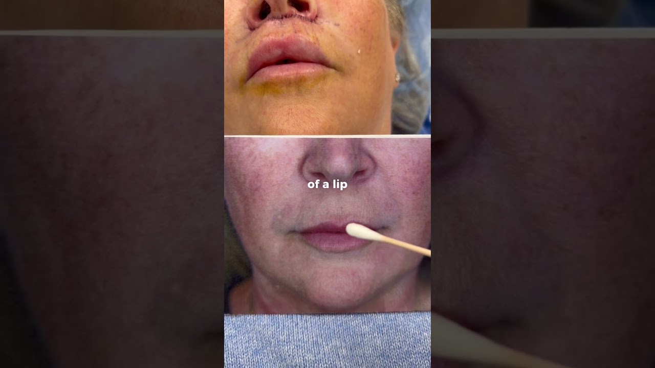 Minutes after a surgical lip lift 💋