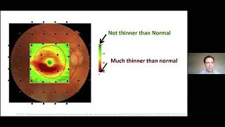 Glaucoma Diagnostics in COVID 19 and Beyond