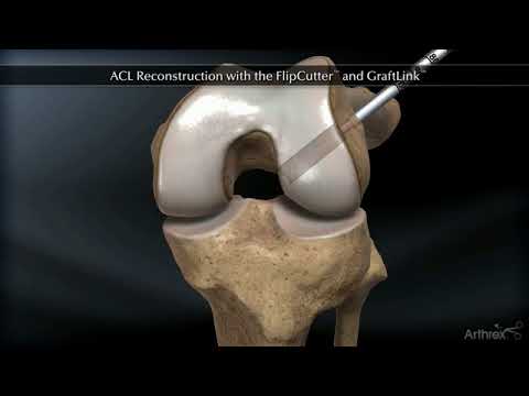 ACL Reconstruction with the FlipCutter and GraftLink