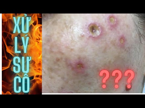 Video Cách xử lý sự cố sau khi trị tàn nhang bằng đốt điện |... - youtube