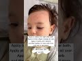 Top 10 Tips To Heal Baby Eczema 