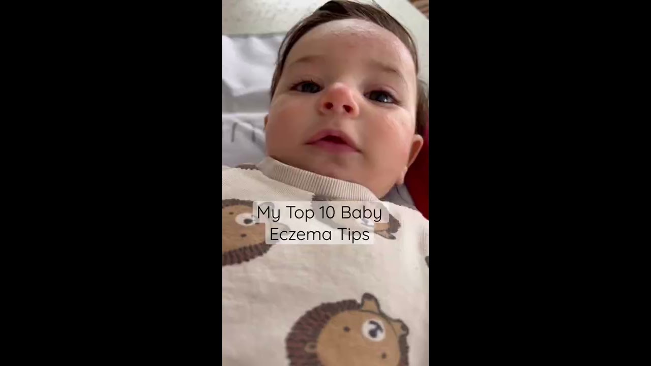 Top 10 Tips to Heal Baby Eczema