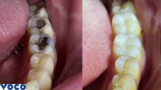 Aesthetic and biocompatible: Admira Fusion – the universal restorative material