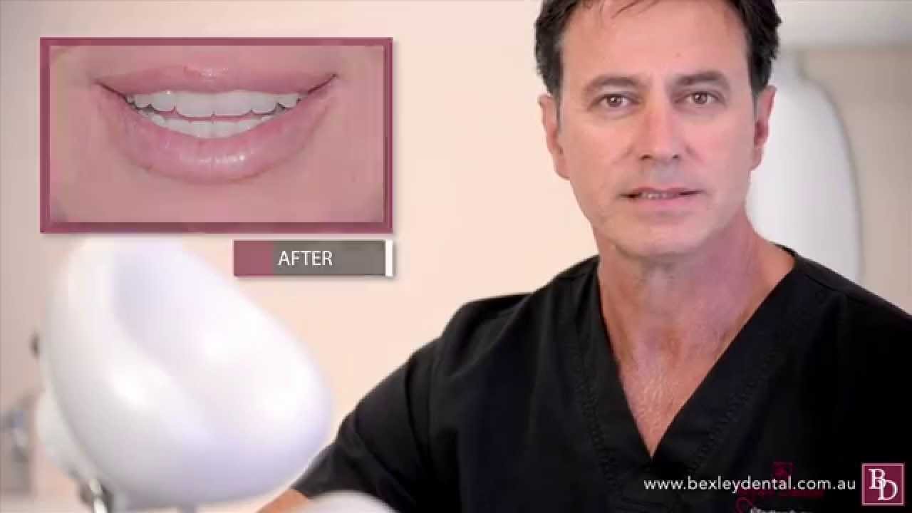 ALL ON 4 BEXLEY DENTAL YouTube