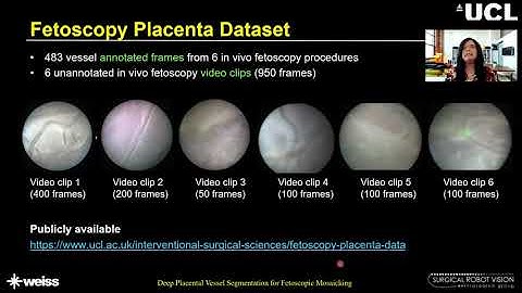 [MICCAI 2020] Oral: Deep Placental Vessel Segmentation for Fetoscopic Mosaicking