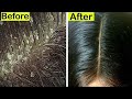 Don&#39;t Ignore These Remedies For Dandruff Removal! GET RID OF DANDRUFF, Remedies For Dandruff