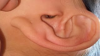 Professional Ear Cleaning Ears