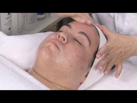 Diet Related Acne And Facial With Alessandra Part 