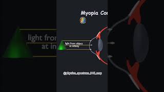 Myopia Correction Explained | Concave Lens Trick You Must Know 👀 #physics #myopia