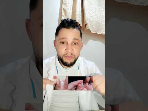 الفطريات بين أصابع القدمين